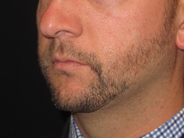Chin Implant before at Kramer Plastic Surgery in Meridian, ID