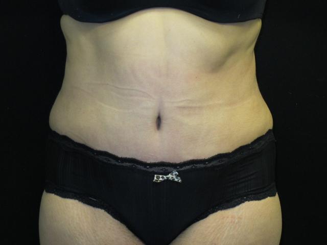 Mini Tummy Tuck after at Kramer Plastic Surgery in Meridian, ID