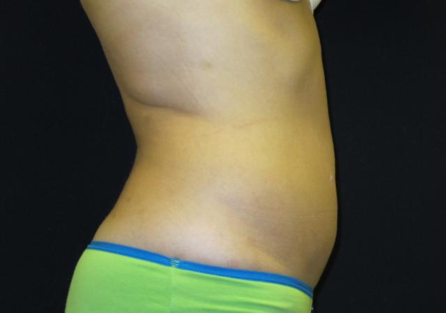 Thigh Lift after at Kramer Plastic Surgery in Meridian, ID