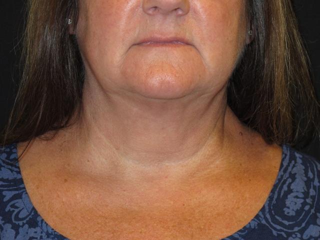 Kybella after at Kramer Plastic Surgery in Meridian, ID