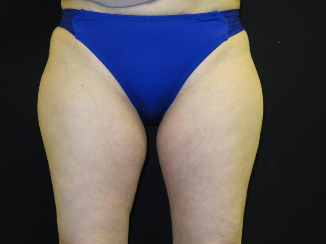 Thigh Lift before at Kramer Plastic Surgery in Meridian, ID