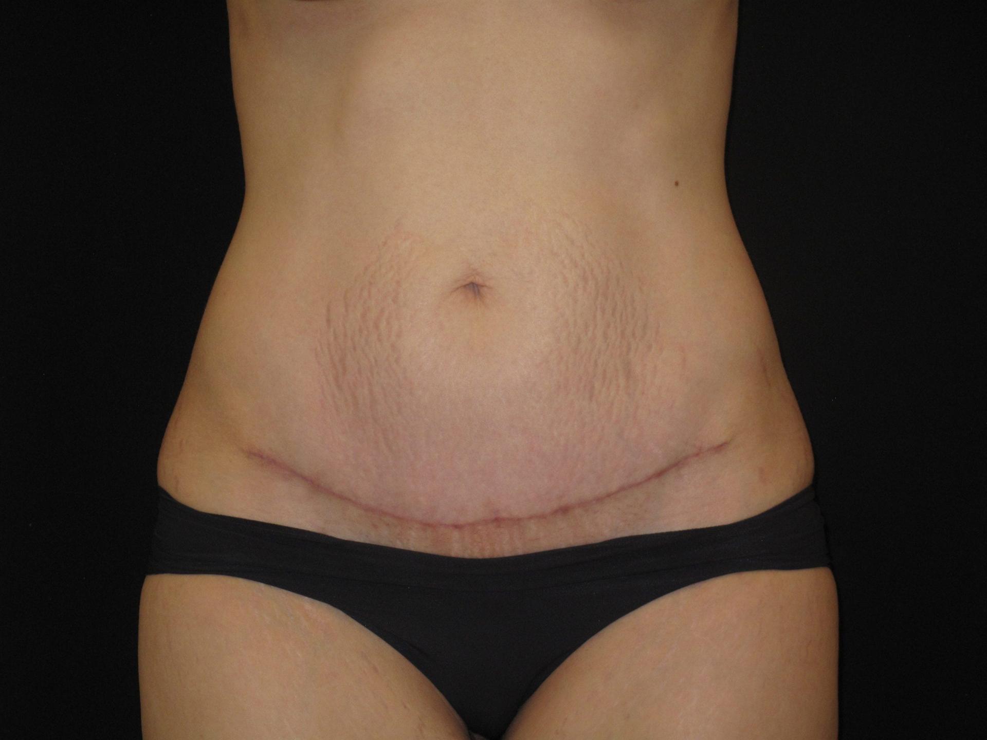 Kramer Plastic Surgery tummy tuck after — Meridian, ID