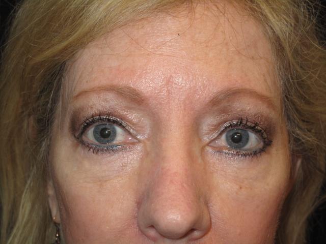 Blepharoplasty after at Kramer Plastic Surgery in Meridian, ID
