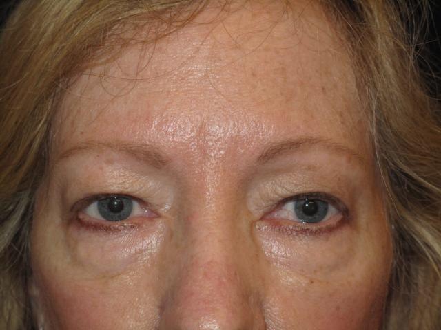 Blepharoplasty before at Kramer Plastic Surgery in Meridian, ID