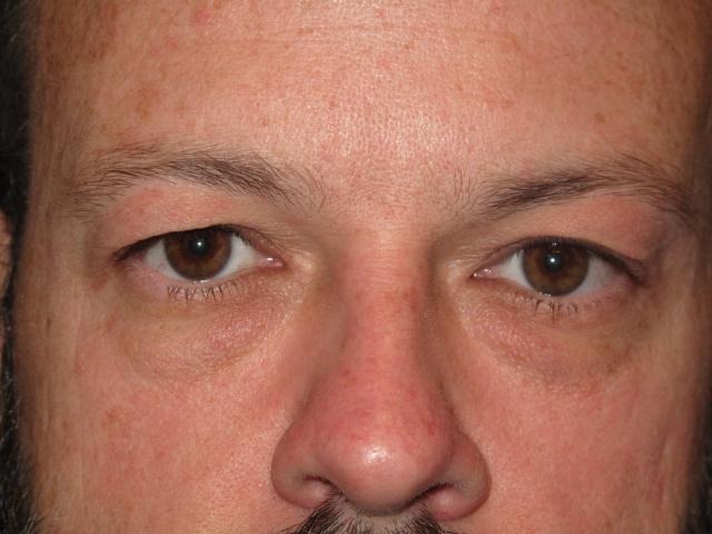 Blepharoplasty before at Kramer Plastic Surgery in Meridian, ID