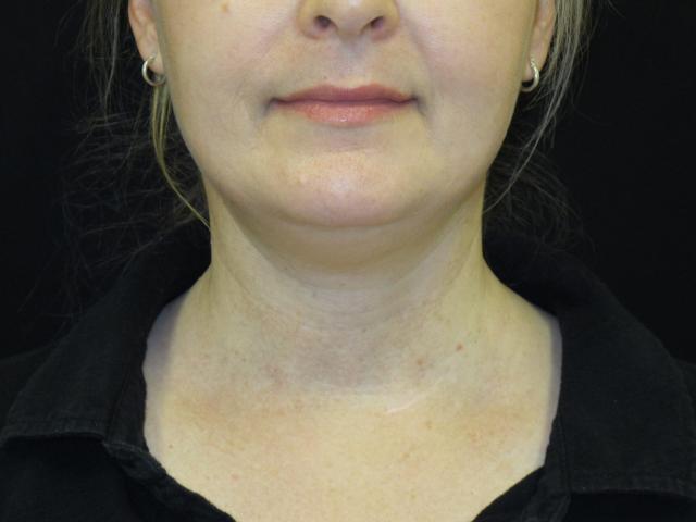 Kybella before at Kramer Plastic Surgery in Meridian, ID