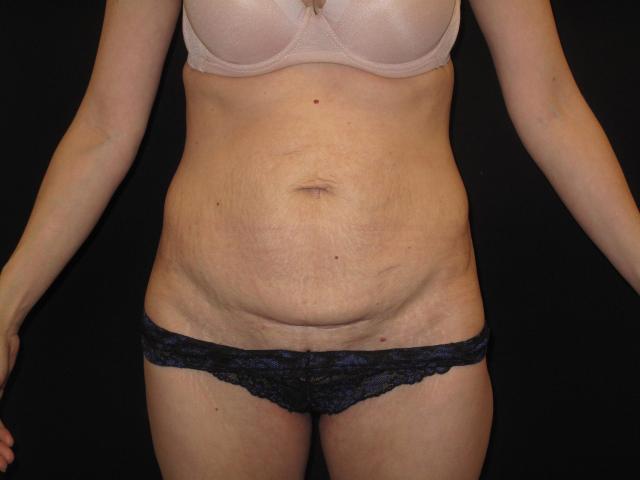 Mini Tummy Tuck before at Kramer Plastic Surgery in Meridian, ID