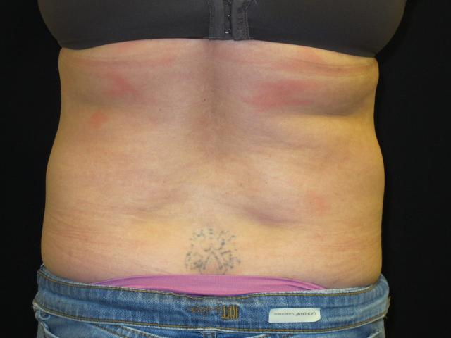 Arm Lift after at Kramer Plastic Surgery in Meridian, ID