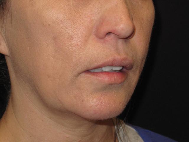 Chin Implant after at Kramer Plastic Surgery in Meridian, ID