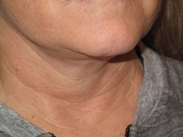 Facelift after at Kramer Plastic Surgery in Meridian, ID