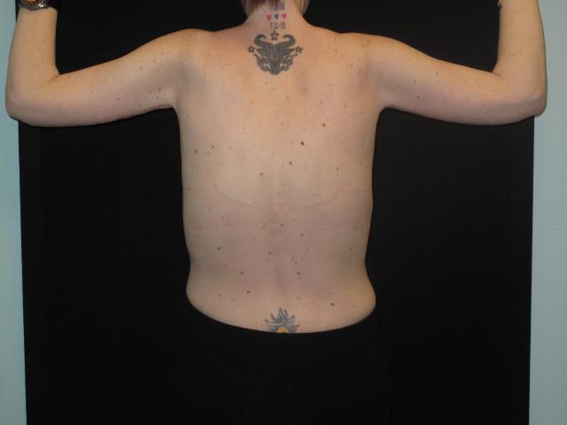 Arm Lift after at Kramer Plastic Surgery in Meridian, ID