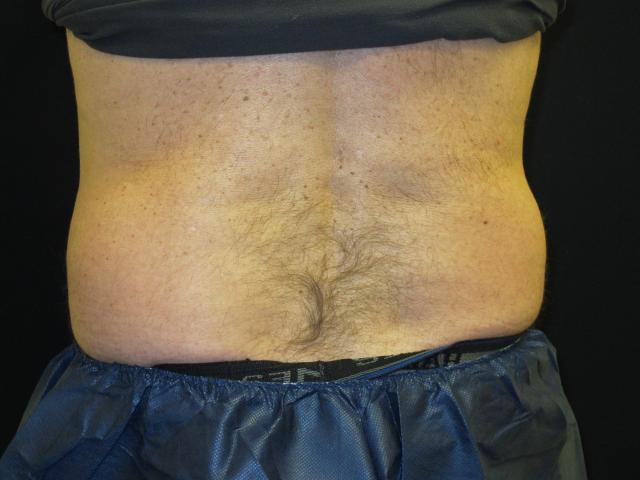 Arm Lift before at Kramer Plastic Surgery in Meridian, ID
