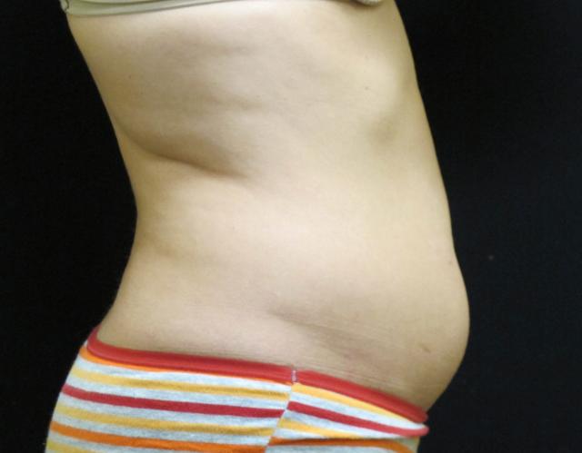 Thigh Lift before at Kramer Plastic Surgery in Meridian, ID