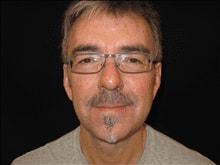 Mini Facelift after at Kramer Plastic Surgery in Meridian, ID