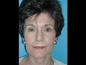 Facelift after at Kramer Plastic Surgery in Meridian, ID