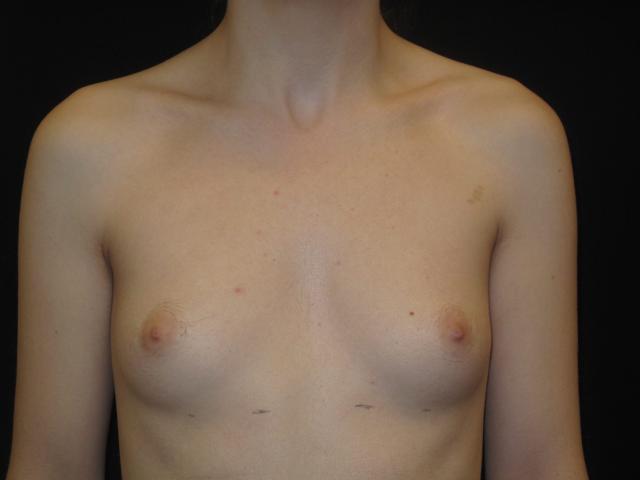 Fat Transfer Breast Augmentation before at Kramer Plastic Surgery in Meridian, ID