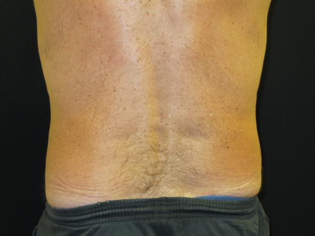 Arm Lift after at Kramer Plastic Surgery in Meridian, ID