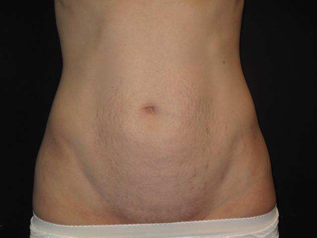 Mommy Makeover before at Kramer Plastic Surgery in Meridian, ID