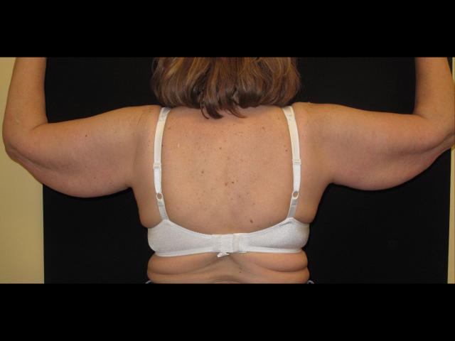 Arm Lift before at Kramer Plastic Surgery in Meridian, ID