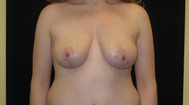 Breast Lift after at Kramer Plastic Surgery in Meridian, ID