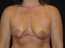 Breast Lift before at Kramer Plastic Surgery in Meridian, ID