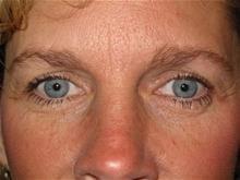 Blepharoplasty after at Kramer Plastic Surgery in Meridian, ID