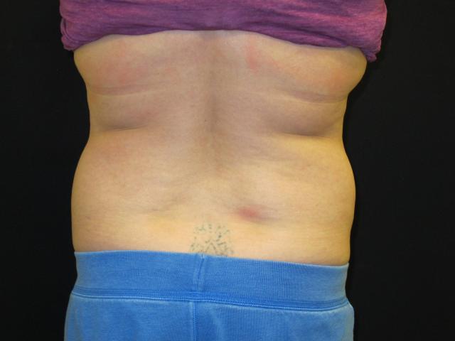 Arm Lift before at Kramer Plastic Surgery in Meridian, ID