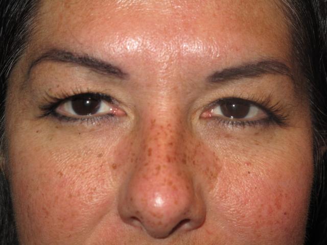Blepharoplasty before at Kramer Plastic Surgery in Meridian, ID