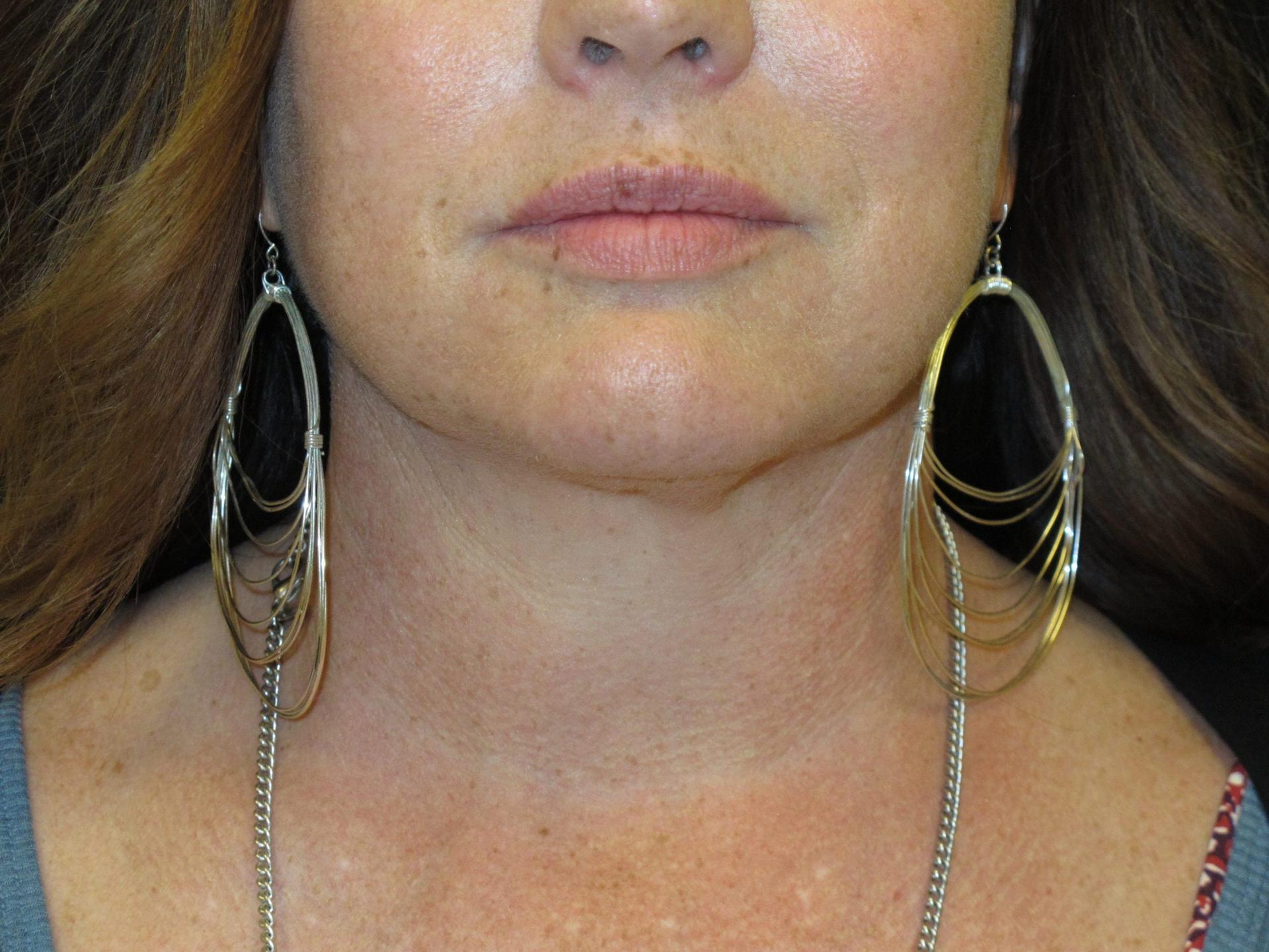 Kramer Plastic Surgery double chin treatment after — Meridian, ID