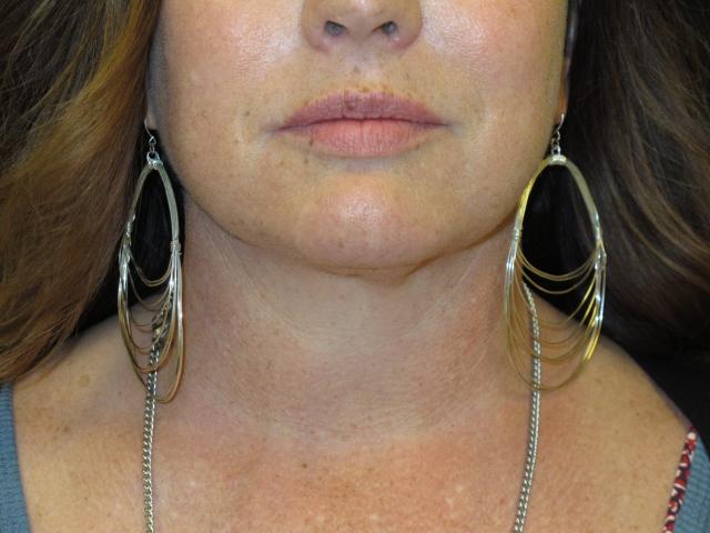 Kybella after at Kramer Plastic Surgery in Meridian, ID