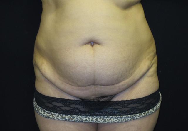 Mini Tummy Tuck before at Kramer Plastic Surgery in Meridian, ID