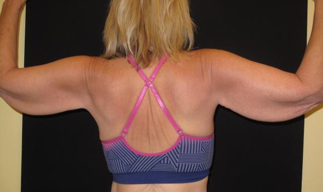 Arm Lift before at Kramer Plastic Surgery in Meridian, ID