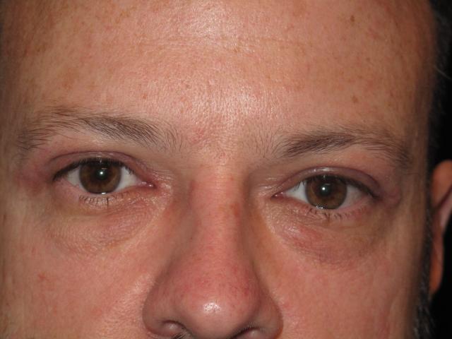 Blepharoplasty after at Kramer Plastic Surgery in Meridian, ID