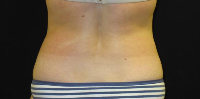 Arm Lift after at Kramer Plastic Surgery in Meridian, ID