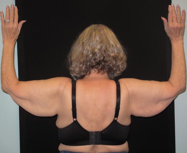 Arm Lift before at Kramer Plastic Surgery in Meridian, ID