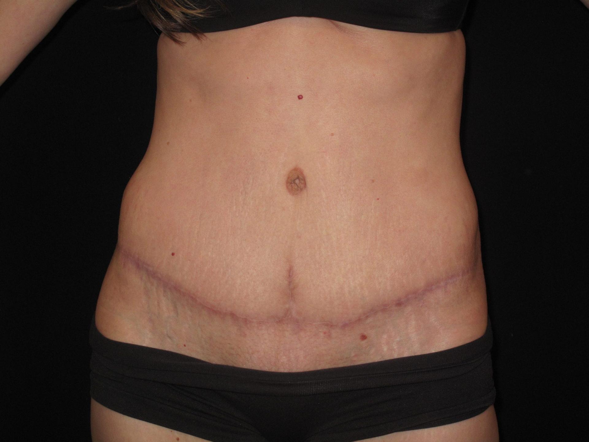 Kramer Plastic Surgery tummy tuck after — Meridian, ID