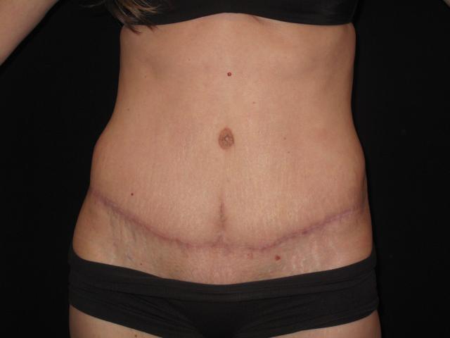 Mini Tummy Tuck after at Kramer Plastic Surgery in Meridian, ID