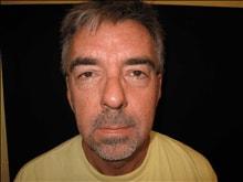 Mini Facelift before at Kramer Plastic Surgery in Meridian, ID