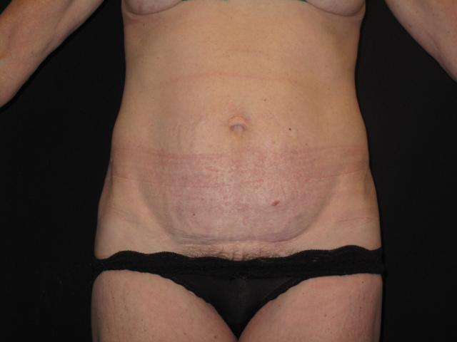 Mommy Makeover before at Kramer Plastic Surgery in Meridian, ID