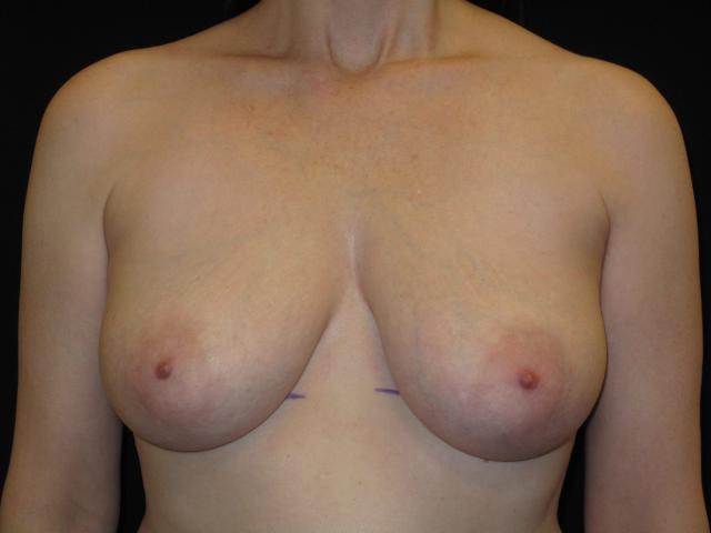 Breast Lift before at Kramer Plastic Surgery in Meridian, ID