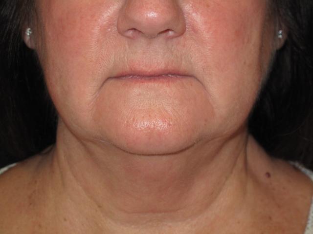 Kybella before at Kramer Plastic Surgery in Meridian, ID