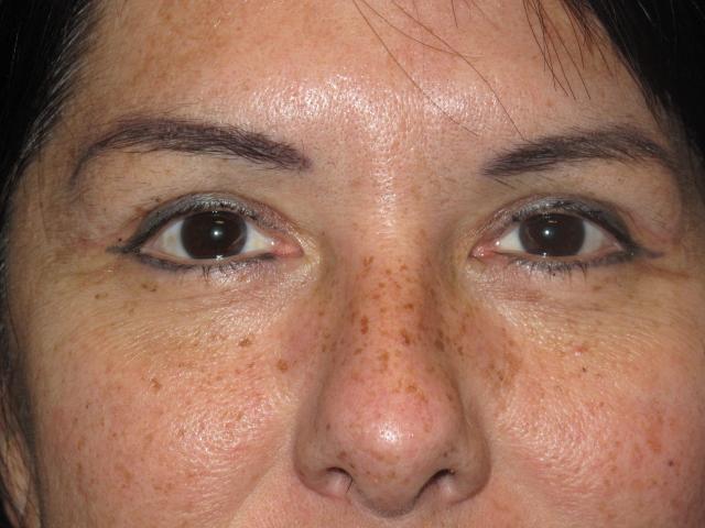 Blepharoplasty after at Kramer Plastic Surgery in Meridian, ID
