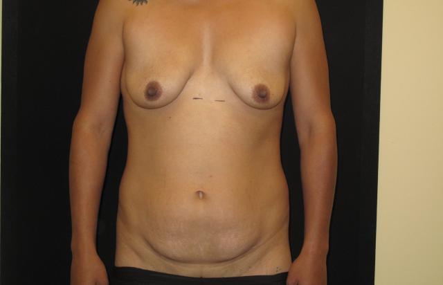 Mommy Makeover before at Kramer Plastic Surgery in Meridian, ID