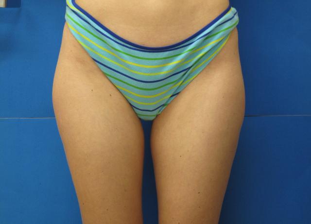 Brazilian Butt Lift after at Kramer Plastic Surgery in Meridian, ID