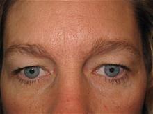 Blepharoplasty before at Kramer Plastic Surgery in Meridian, ID
