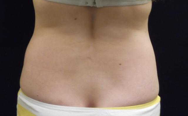 Arm Lift before at Kramer Plastic Surgery in Meridian, ID