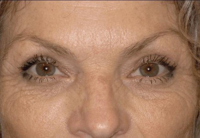 Blepharoplasty after at Kramer Plastic Surgery in Meridian, ID