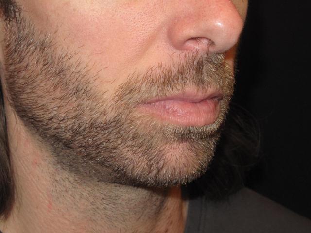 Chin Implant before at Kramer Plastic Surgery in Meridian, ID