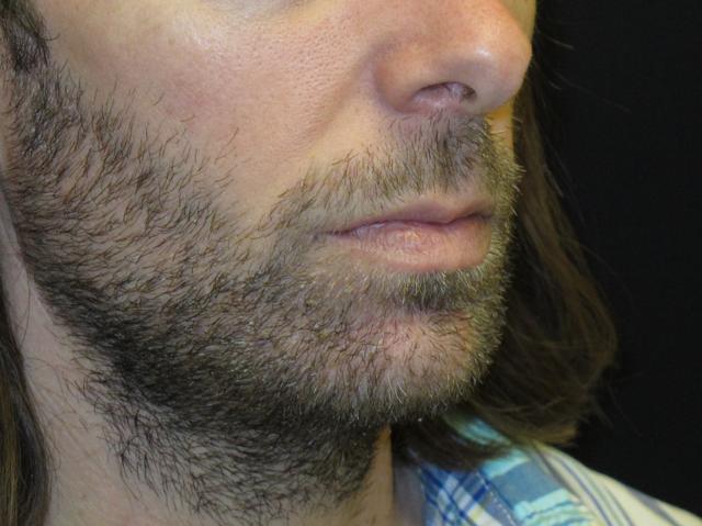 Chin Implant after at Kramer Plastic Surgery in Meridian, ID