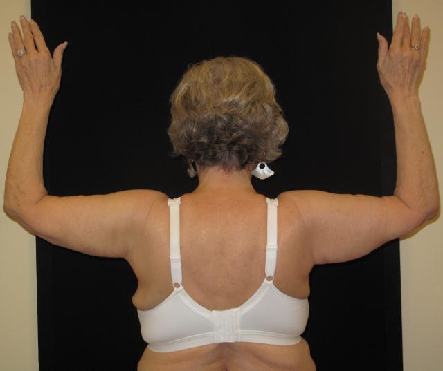 Arm Lift after at Kramer Plastic Surgery in Meridian, ID